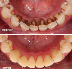 Oral Prophylaxis /  Scaling